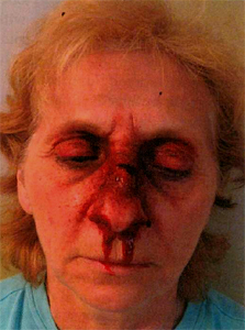 Broken Nose